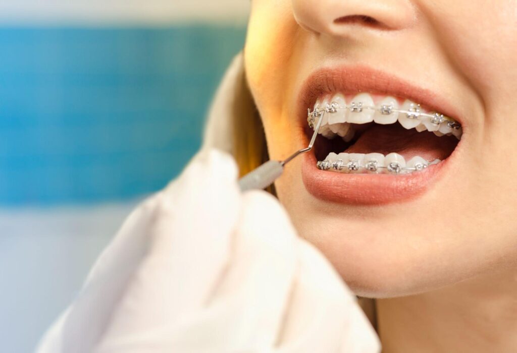Should I Get Braces or Invisalign?